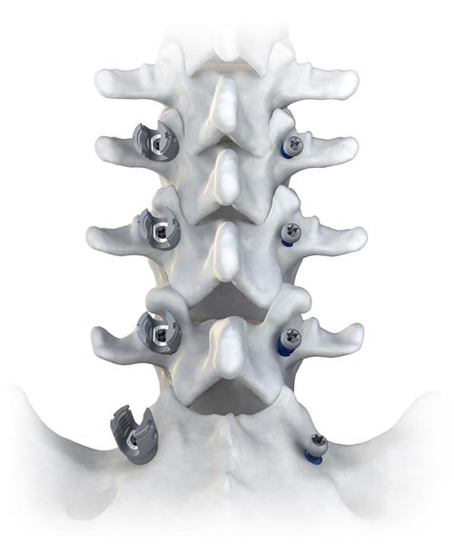 Accelus Introduces LineSider Modular-Cortical System for Posterior Fixation